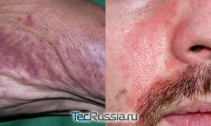Види плям на шкірі, обличчі і тілі - фото і коментарі
