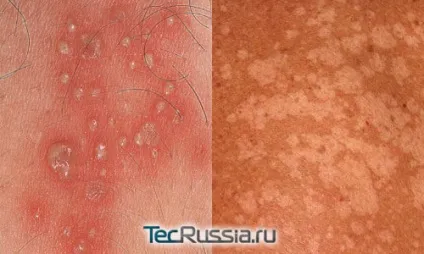 Види плям на шкірі, обличчі і тілі - фото і коментарі