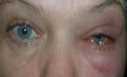 Запалення слізного мішка причини, симптоми, лікування (мішка) Запалення слізного мішка причини, симптоми, лікування