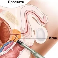 Все про вплив гормонів на структуру передміхурової залози (передміхурової) Все про вплив гормонів на структуру передміхурової залози