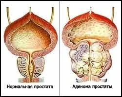Все про вплив гормонів на структуру передміхурової залози (структуру) Все про вплив гормонів на структуру передміхурової залози