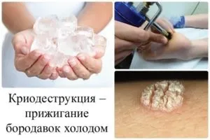 Вульгарні бородавки - причини, симптоми, лікування і народні методи (лікування) Вульгарні бородавки - причини, симптоми, лікування і народні методи