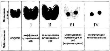 Характеристика функціональної автономії щитовидної залози (щитовидна залоза) Характеристика функціональної автономії щитовидної залози