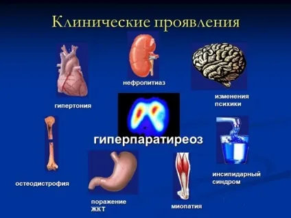 Вторинний гіперпаратиреоз і способи його лікування (способи) Вторинний гіперпаратиреоз і способи його лікування