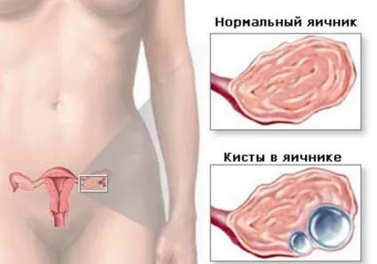 Хронічний ендометріоз - що це таке, симптоми і лікування (лікування) Хронічний ендометріоз - що це таке, симптоми і лікування