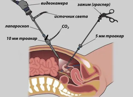 Хронічний ендометріоз - що це таке, симптоми і лікування (хронічний) Хронічний ендометріоз - що це таке, симптоми і лікування