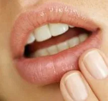 Заїди в куточках рота у дорослих причини і лікування (хвороб числі заед) Заїди в куточках рота у дорослих причини і лікування