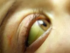 Захворювання печінки і жовчовивідних шляхів, лікування народними засобами (лікування) Захворювання печінки і жовчовивідних шляхів, лікування народними засобами