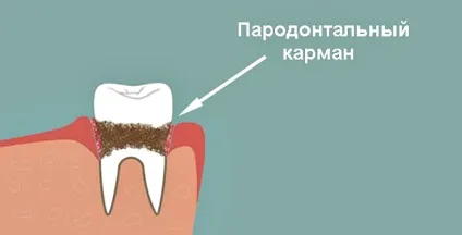 Застрягла їжа між зубами причини, наслідки, що робити і як лікувати (застрягла) Застрягла їжа між зубами причини, наслідки, що робити і як лікувати