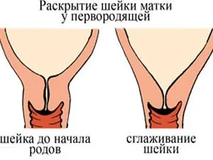 Значить шийка матки довга перед пологами, перед пологами (значить) Значить шийка матки довга перед пологами, перед пологами