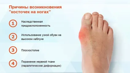 Видалення кісточок на ногах відгуки, переваги лазерної хірургії, заходи профілактики (профілактика) Видалення кісточок на ногах відгуки, переваги лазерної хірургії, заходи профілактики