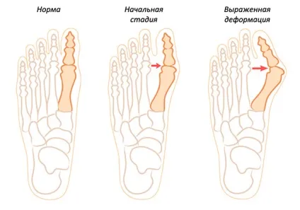 Видалення кісточок на ногах відгуки, переваги лазерної хірургії, заходи профілактики (лазерної) Видалення кісточок на ногах відгуки, переваги лазерної хірургії, заходи профілактики