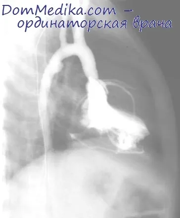 Зондування серця при дефекті міжпередсердної перегородки (перегородки) Зондування серця при дефекті міжпередсердної перегородки