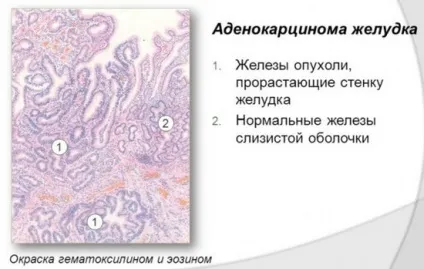 Аденокарцинома шлунку причини, симптоми і лікування (аденокарцинома) Аденокарцинома шлунку причини, симптоми і лікування