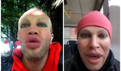 Олександр шпак до і після пластичних операцій, фото і відео