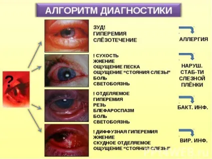 Алергія на століттях очей - причини, симптоми і лікування, мазі від алергії (алергія) Алергія на століттях очей - причини, симптоми і лікування, мазі від алергії