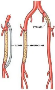 Аорто-стегнової шунтування (хірургічного втручання є) Аорто-стегнової шунтування
