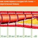 Бляшки на судинах і причини їх появи (появи) Бляшки на судинах і причини їх появи