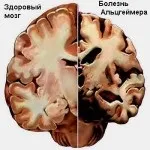 Бляшки на судинах і причини їх появи (бляшки) Бляшки на судинах і причини їх появи