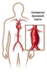 хвороби аорти