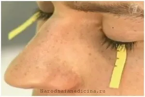 хвороба Шегрена