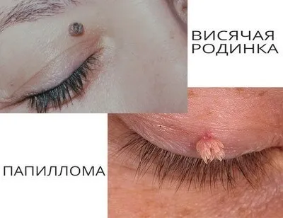 Бородавки, родимки і папіломи чим вони відрізняються