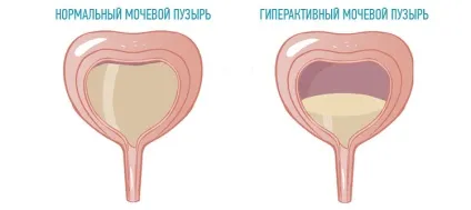 Хвороби сечового міхура у жінок діагностика, симптоми, лікування