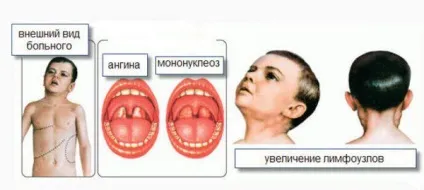 Болить горло, боляче ковтати - чим лікувати в домашніх умовах, що робити дитині, якщо сильно (боляче) Болить горло, боляче ковтати - чим лікувати в домашніх умовах, що робити дитині, якщо сильно