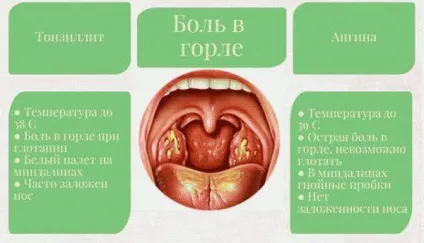 Болить горло, боляче ковтати - чим лікувати в домашніх умовах, що робити дитині, якщо сильно (домашніх) Болить горло, боляче ковтати - чим лікувати в домашніх умовах, що робити дитині, якщо сильно