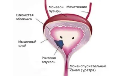 Хвороби сечового міхура у жінок діагностика, симптоми, лікування