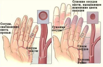 Хвороба Рейно лікування, симптоми, профілактика (Рейно) Хвороба Рейно лікування, симптоми, профілактика