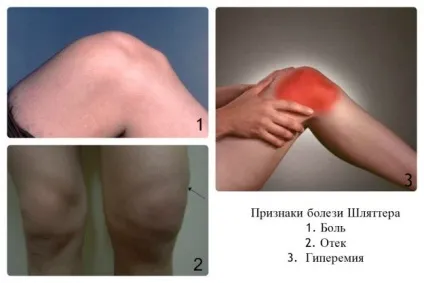 Хвороба Осгуд-Шляттера на відео - як виглядають шишки, викликані хворобою Шляттера, під колінними чашечками (Шляттера) Хвороба Осгуд-Шляттера на відео - як виглядають шишки, викликані хворобою Шляттера, під колінними чашечками
