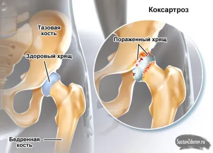 Хвороби тазостегнового суглоба симптоми, лікування, відгуки (фото) (хвороби) Хвороби тазостегнового суглоба симптоми, лікування, відгуки (фото)