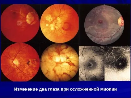Короткозорість (міопія) - все що потрібно знати - зір на 100 (міопія) Короткозорість (міопія) - все що потрібно знати - зір на 100