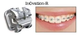 Брекети нового покоління gcorthodontics in ovation r, s, experience metal, легенд медіум, тино і (міні легаси) Брекети нового покоління gcorthodontics in ovation r, s, experience metal, легенд медіум, тино і
