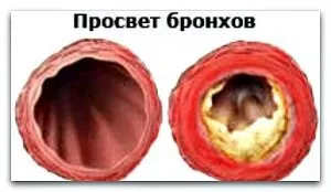 Кинув палити як очистити легені бронхи, очищення організму (очистити) Кинув палити як очистити легені бронхи, очищення організму