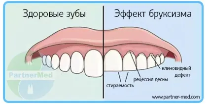 Бруксизм у дорослих причини і лікування (чи є зв'язок?) Бруксизм у дорослих причини і лікування