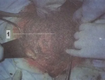 Cанація і дренування черевної порожнини в післяопераційному перитоніті - медичний довідник