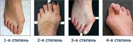 Вальгусна деформація стопи у дітей і дорослих способи діагностики і лікування, профілактика (вальгусна деформація стопи) Вальгусна деформація стопи у дітей і дорослих способи діагностики і лікування, профілактика
