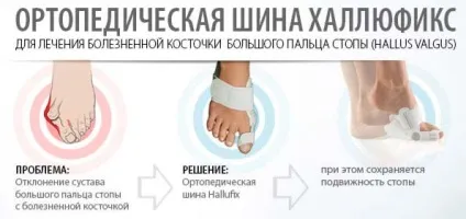 Вальгусна деформація стопи у дітей і дорослих способи діагностики і лікування, профілактика (дітей) Вальгусна деформація стопи у дітей і дорослих способи діагностики і лікування, профілактика