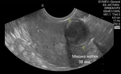 Узі міоми матки коли робити ехографію і чи можна побачити рак (робити) Узі міоми матки коли робити ехографію і чи можна побачити рак