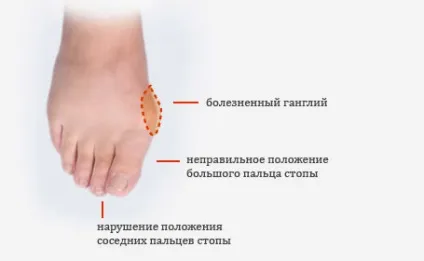 Вальгусна деформація стопи у дітей і дорослих способи діагностики і лікування, профілактика (стопи) Вальгусна деформація стопи у дітей і дорослих способи діагностики і лікування, профілактика