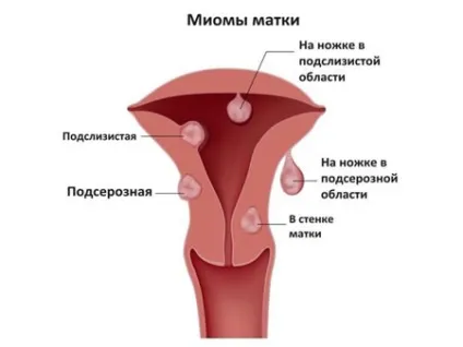 Узі міоми матки коли робити ехографію і чи можна побачити рак (ехографію) Узі міоми матки коли робити ехографію і чи можна побачити рак
