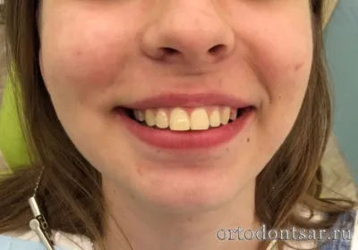 Чим загрожує неправильний прикус все наслідки (чим загрожує неправильний прикус) Чим загрожує неправильний прикус все наслідки
