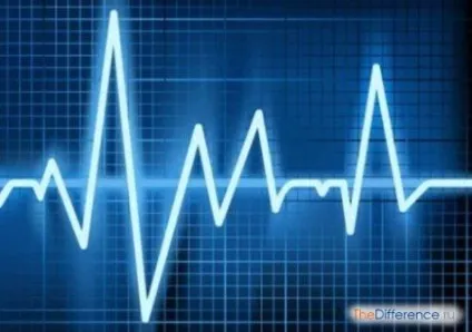 Чим відрізняється аритмія від тахікардії, в чому різниця (відрізняється) Чим відрізняється аритмія від тахікардії, в чому різниця