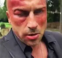 Що трапилося з Нагієвим звідки у нього шрам новини онлайн (трапилося) Що трапилося з Нагієвим звідки у нього шрам новини онлайн
