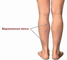Що таке коагуляція, ніж вона може бути викликана, які ускладнення можливі в результаті (лазер) Що таке коагуляція, ніж вона може бути викликана, які ускладнення можливі в результаті