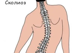 Що собою являє анталгический сколіоз (сколіоз) Що собою являє анталгический сколіоз