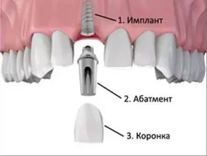 Що таке абатмент і навіщо його застосовують в в стоматології види, виробники, установка (установка) Що таке абатмент і навіщо його застосовують в в стоматології види, виробники, установка
