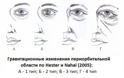 Що важливо врахувати, плануючи хірургічну корекцію периорбитальной області (корекцію) Що важливо врахувати, плануючи хірургічну корекцію периорбитальной області